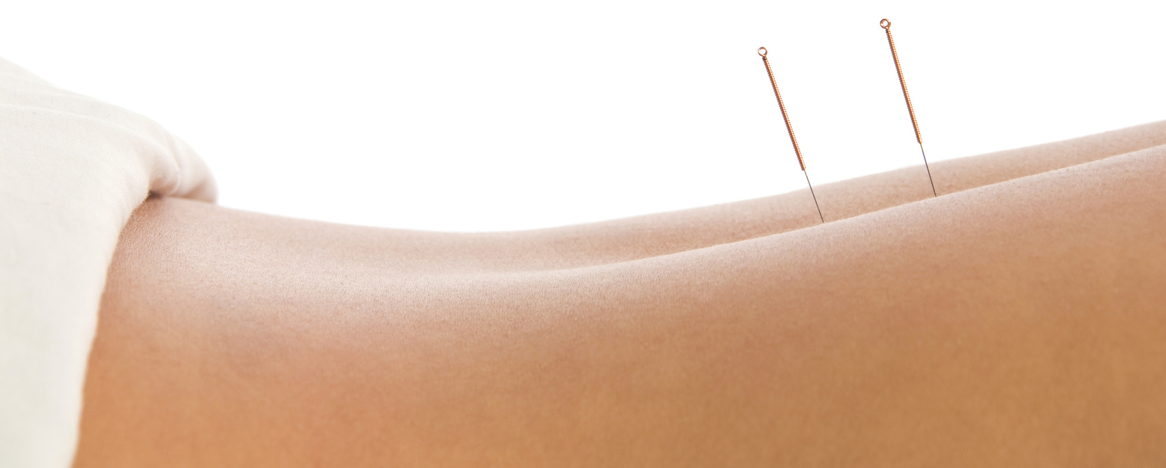 Woman getting an acupuncture treatment in a spa